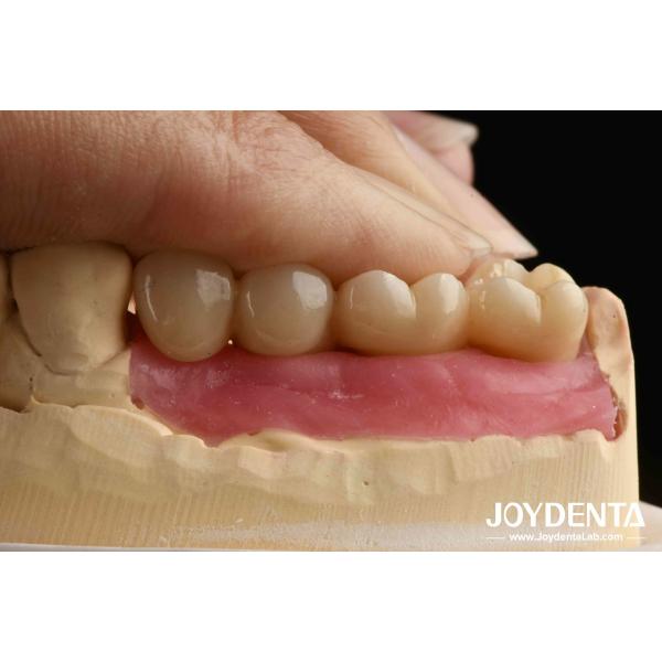 Quality Ultra-precision processing Zirconia Implants All-Zirconium Integrated Crown for sale