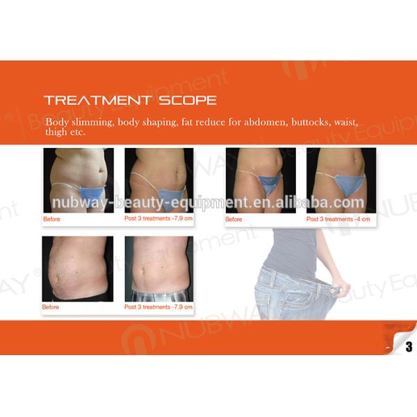 HIFU Body Fat Slimming! Newest Ultrashape Machine High Intensity Focused Ultrasound HIFU
