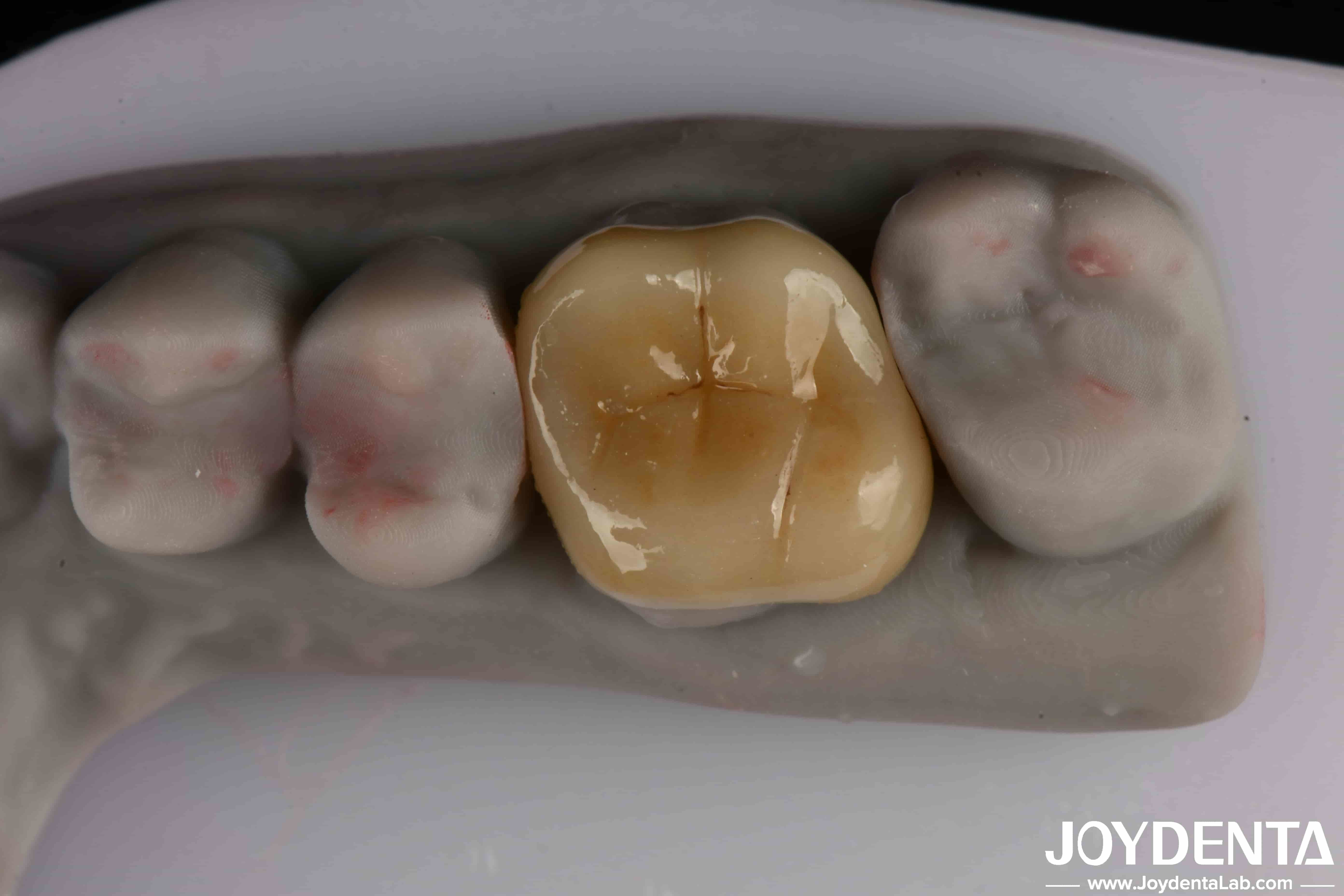  Easy To Clean And Durable Emax Inlay Onlay Resistance To Staining For Optimal Performance Manufactures
