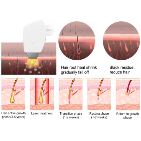 Pvc Q Switch Diode Laser Hair Removal Machine 3000w